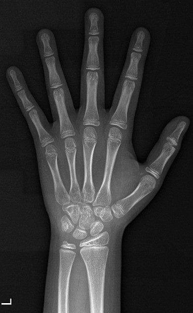 left hand x ray