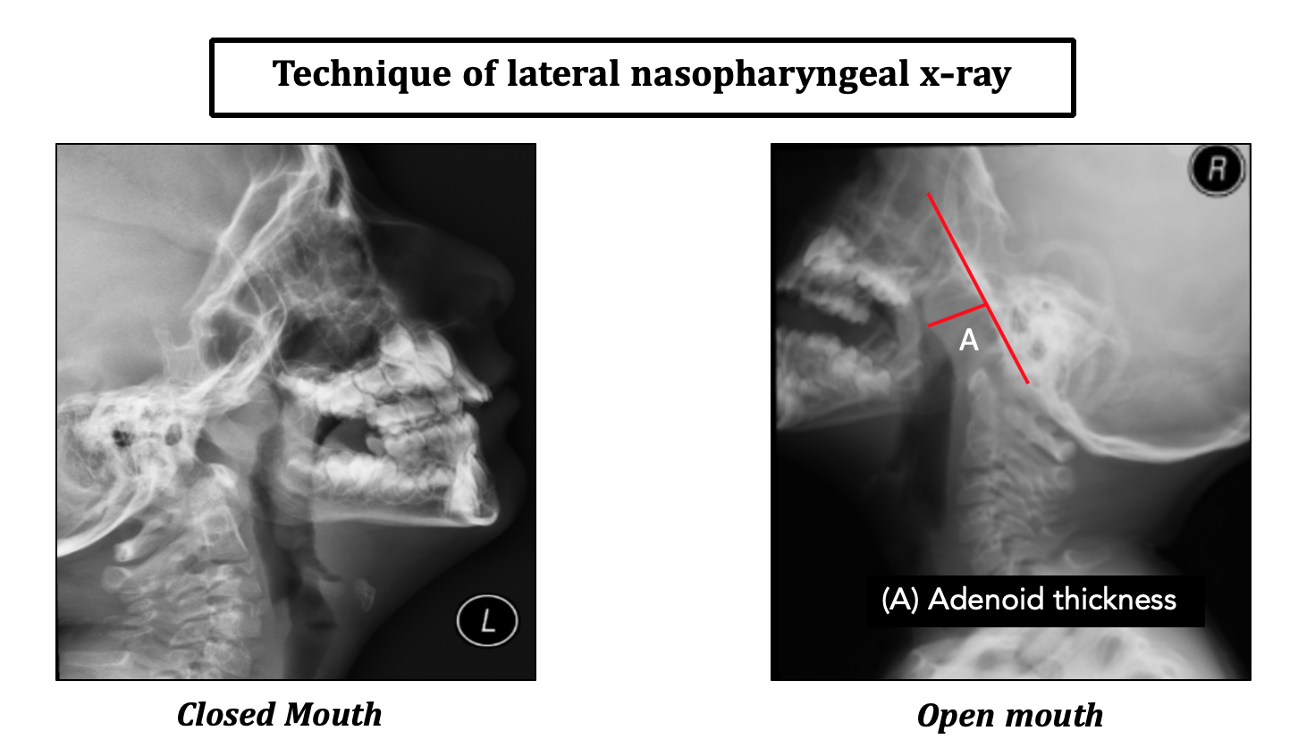 adenoid hypertrophy x ray