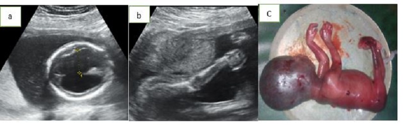 club foot ultrasound