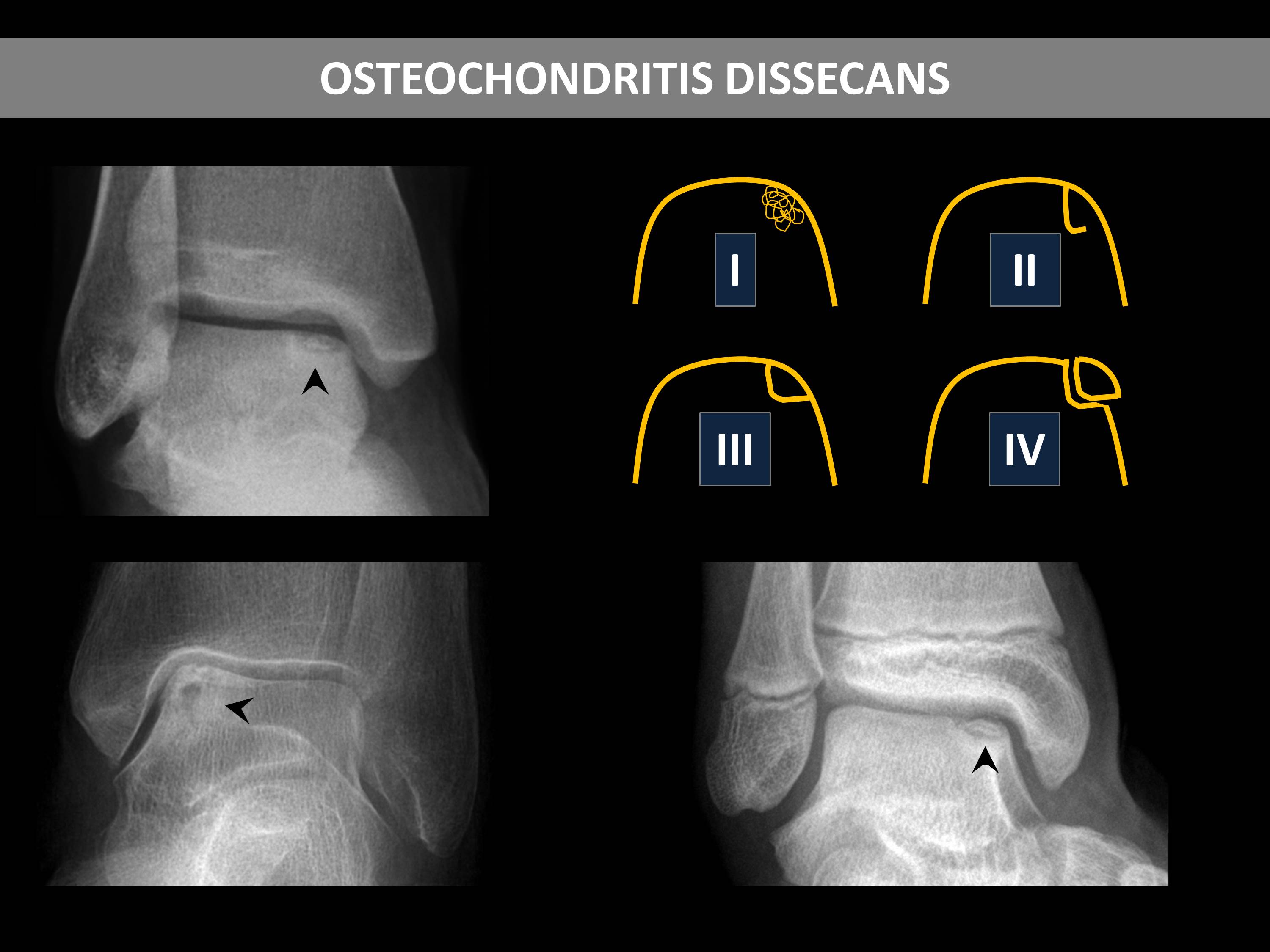 a vállízület kezelése subchondral osteosclerosis ban zsibbadás rheumatoid arthritisben