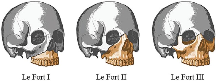 le fort fracture