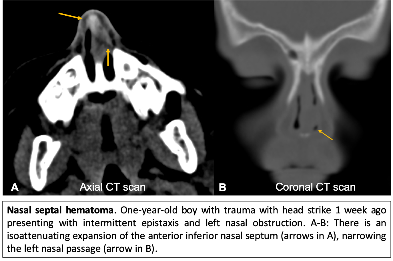 nasal septal hematoma