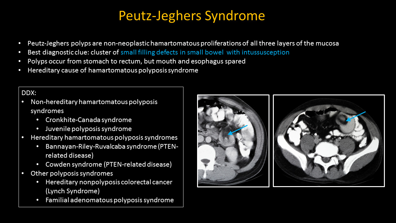 peutz jeghers syndrome