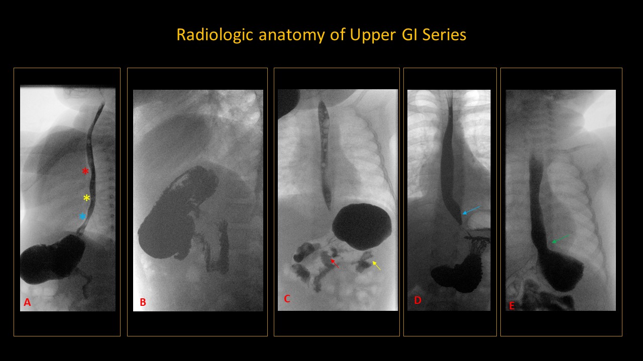 upper-and-lower-gi-endoscopy-arya-wellness-centre