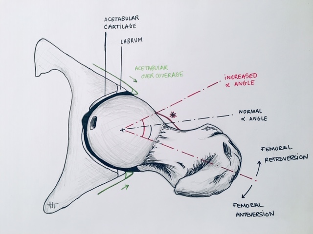 femoral anteversion angle