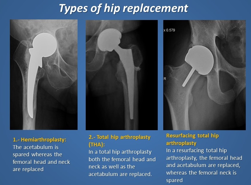 total hip vs hemiarthroplasty femoral neck fracture