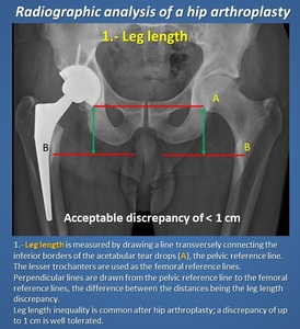 Complications of total hip arthroplasty, Radiology Reference Article