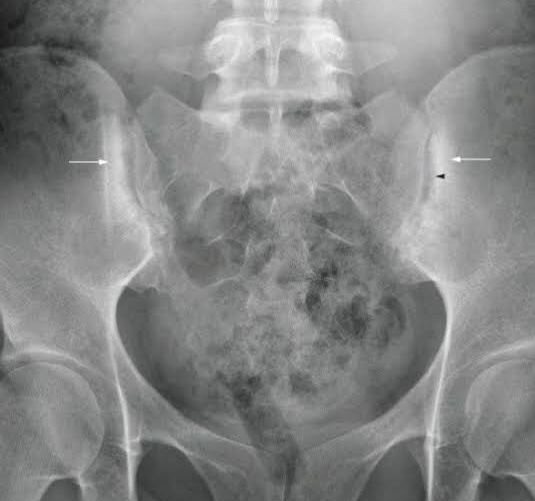 sacroiliac joint x ray
