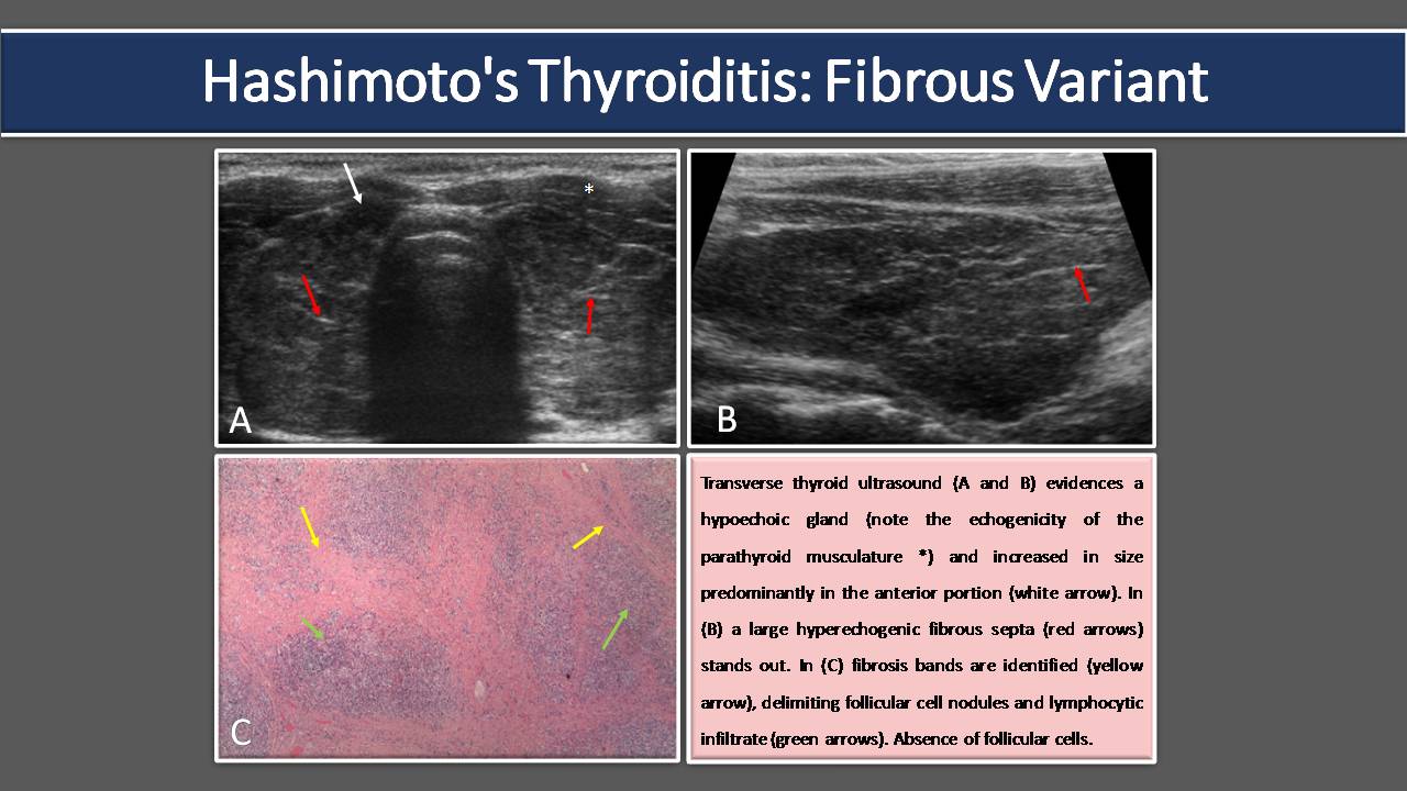 thyroid ultrasound hashimotos