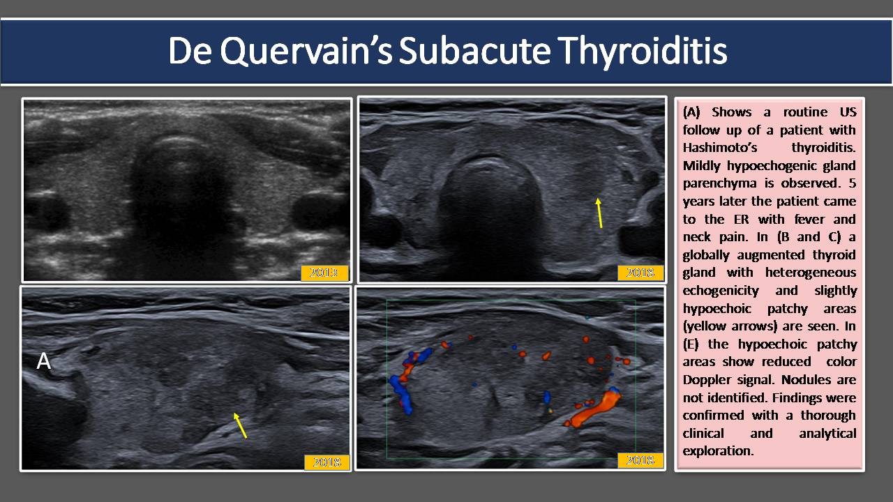 subacute thyroiditis ultrasound