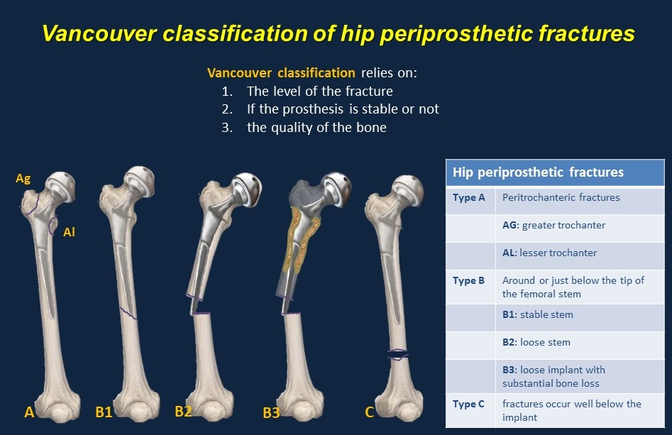 Vancouver Classification For Periprosthetic Femoral Fractures Around ...
