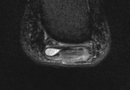 Sensors | Free Full-Text | Ultrasonography Features of the Plantar Fascia  Complex in Patients with Chronic Non-Insertional Achilles Tendinopathy: A  Case-Control Study