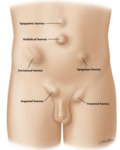 Região Femoral e Hérnias: Anatomia - Lecturio Medical