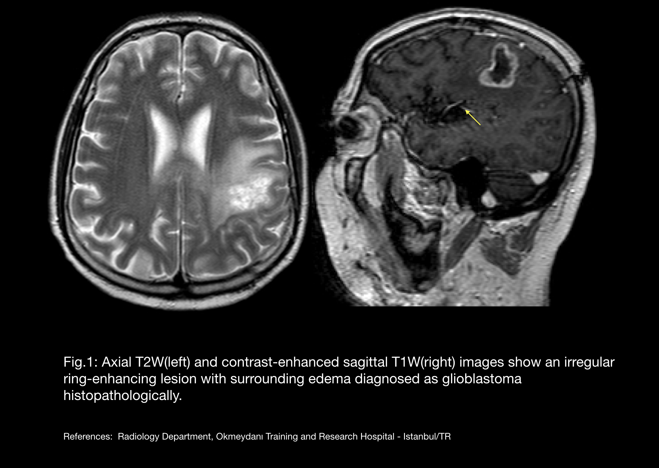Ring enhancing cerebral metastasis | Image | Radiopaedia.org