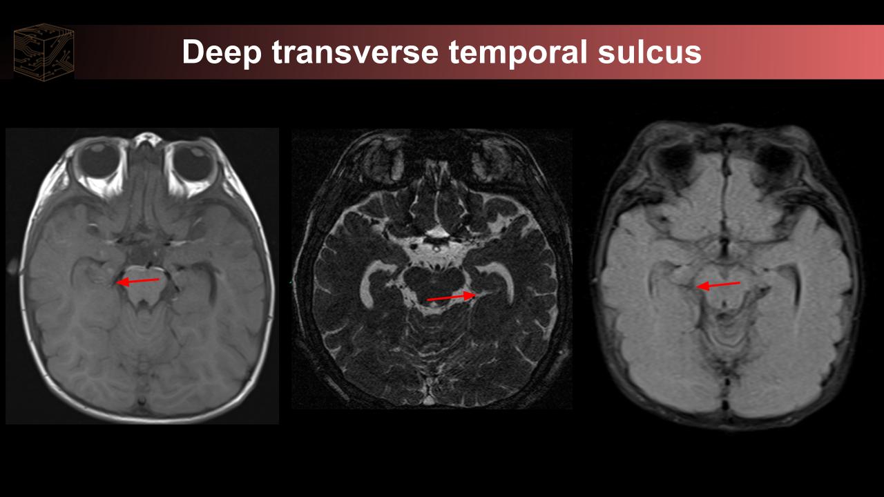 transverse temporal sulcus