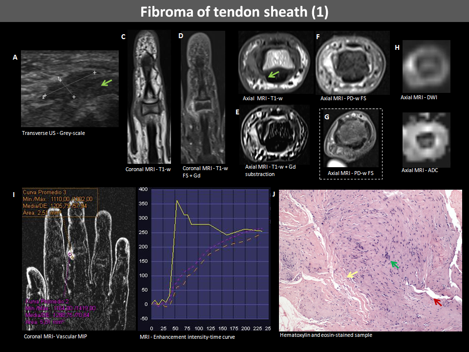fibroma of tendon sheath