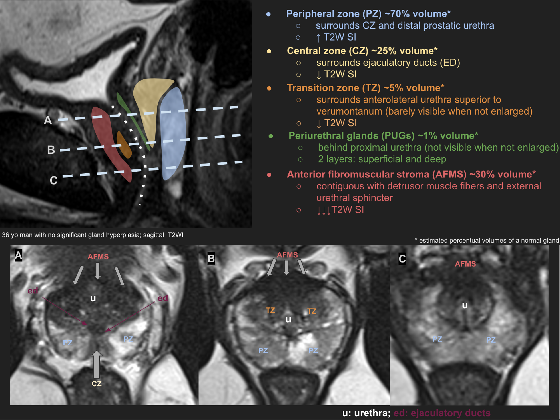 prostate gland zonal anatomy