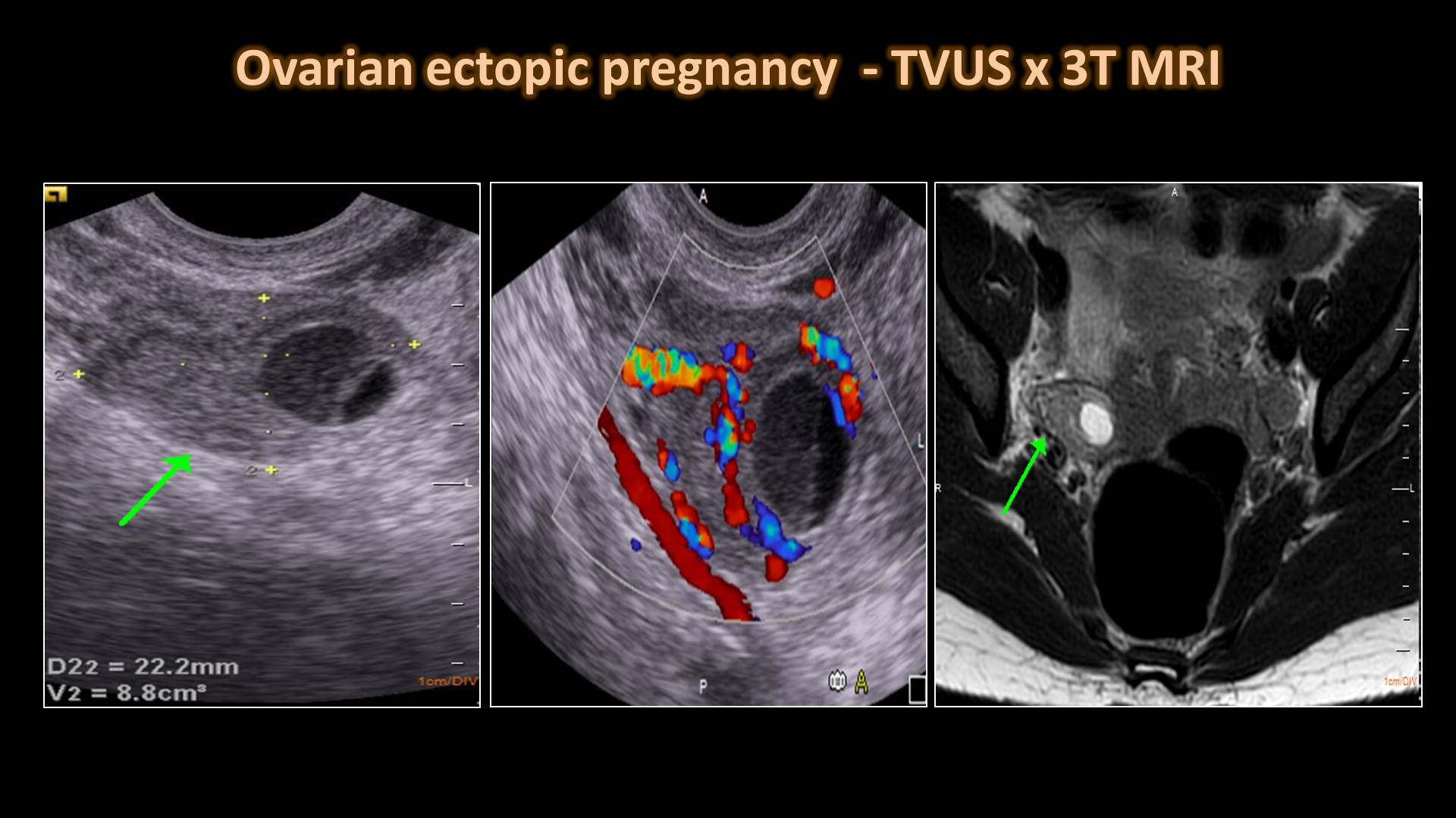 ovarian ectopic pregnancy ultrasound