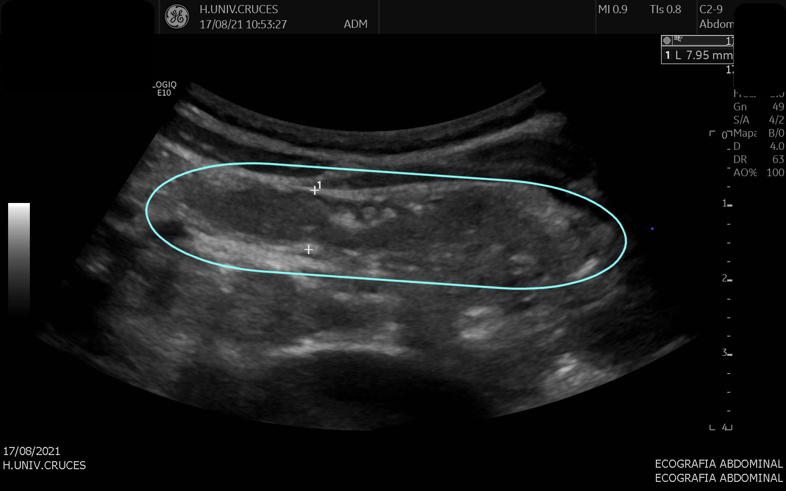 terminal ileum ultrasound