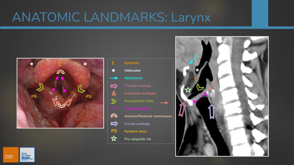 posterior commissure larynx