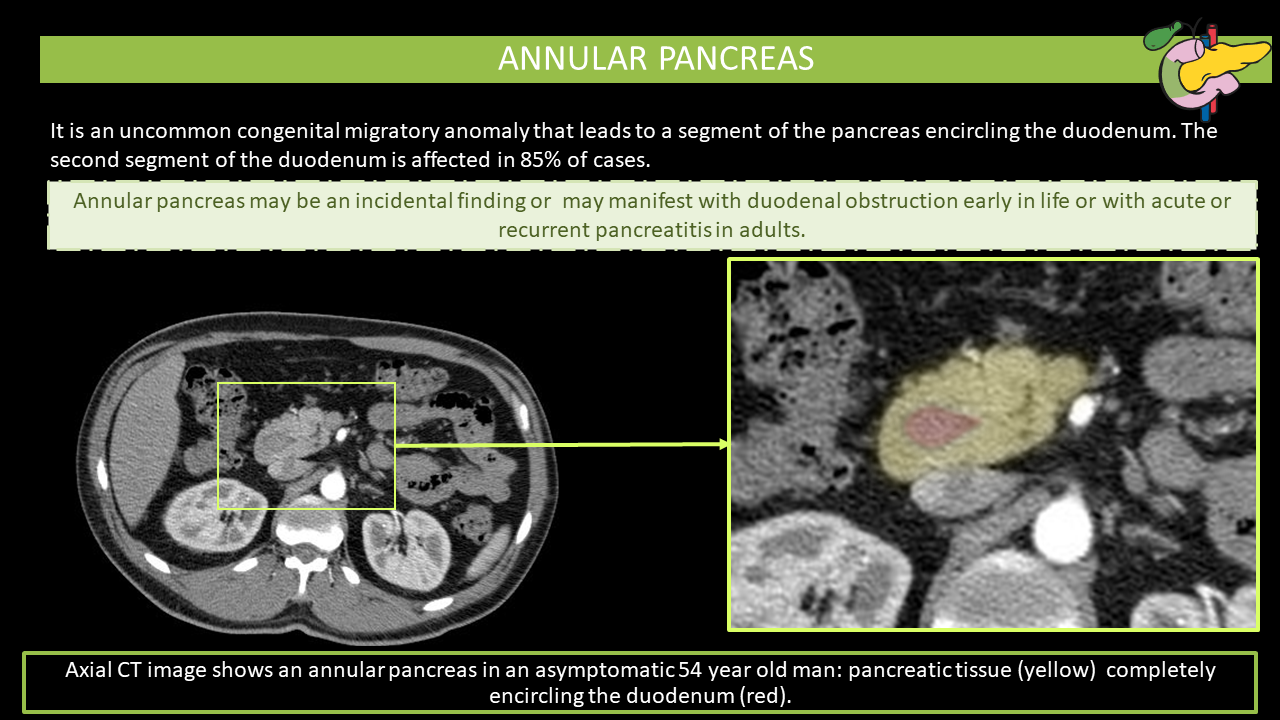 annular pancreas