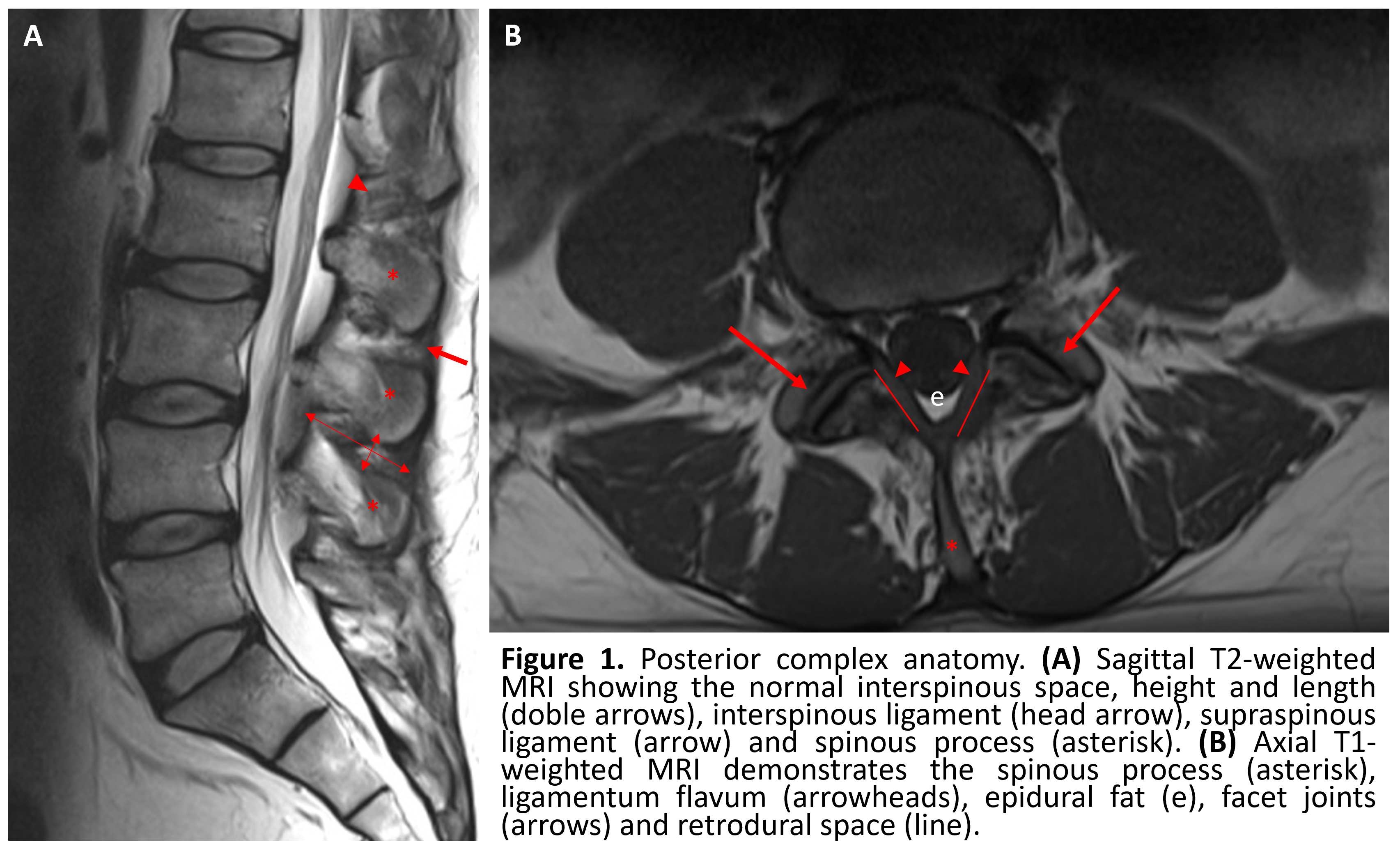 The vertebral column usually contains three curves. The cervical and lumbar  curves are convex anteriorly, and the thoracic curve is convex posteriorly.  These curves, together with gravity, barricity of the local anesthetic,, image size:3410x2072