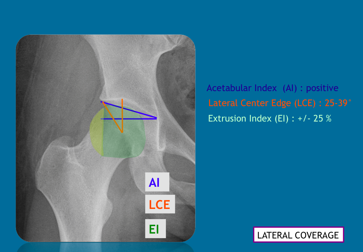 α) Cup center-edge (Cup-CE) angle. Bone coverage index (BCI) The