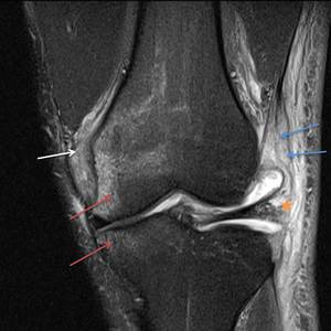 A) MRI findings: the typical bunched medial collateral ligament (MCL)