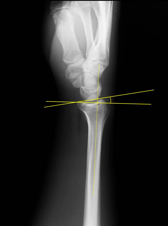 x ray wrist lateral view
