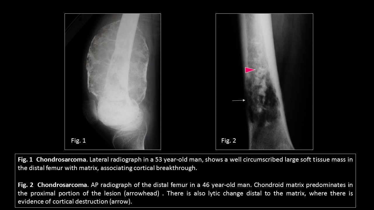 chondrosarcoma x ray