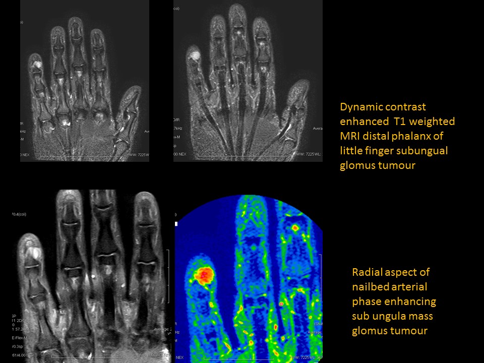 Glomus Tumor | The Hand Treatment Center - New Jersey/New York Hand Surgeon