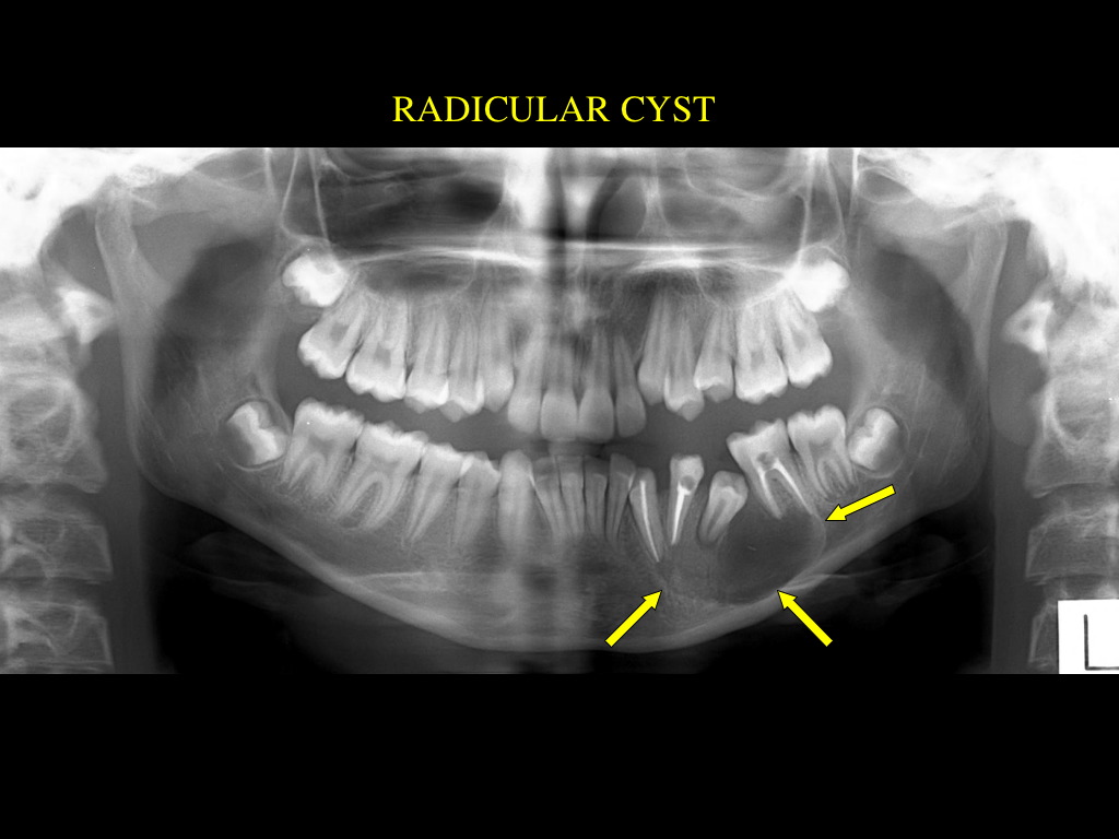 odontogenic keratocyst radiology