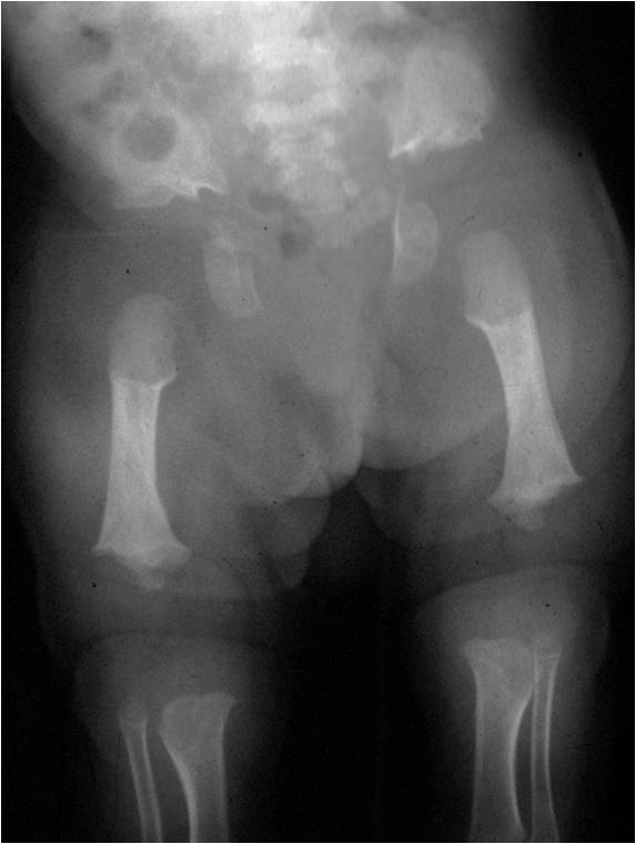 achondroplasia x ray baby