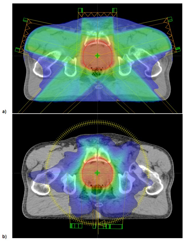 radiation therapy imrt prostate cancer