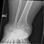 Radiographic analysis of adult ankle fractures using combined