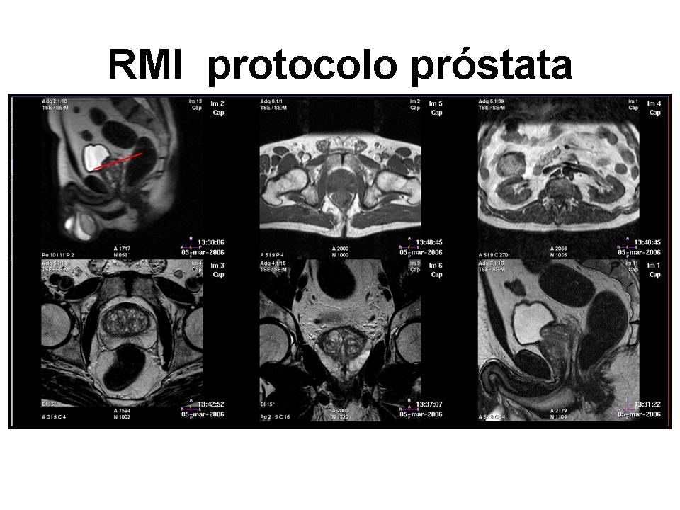 anatomia prostata rm seram