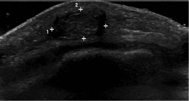 prepatellar bursitis ultrasound