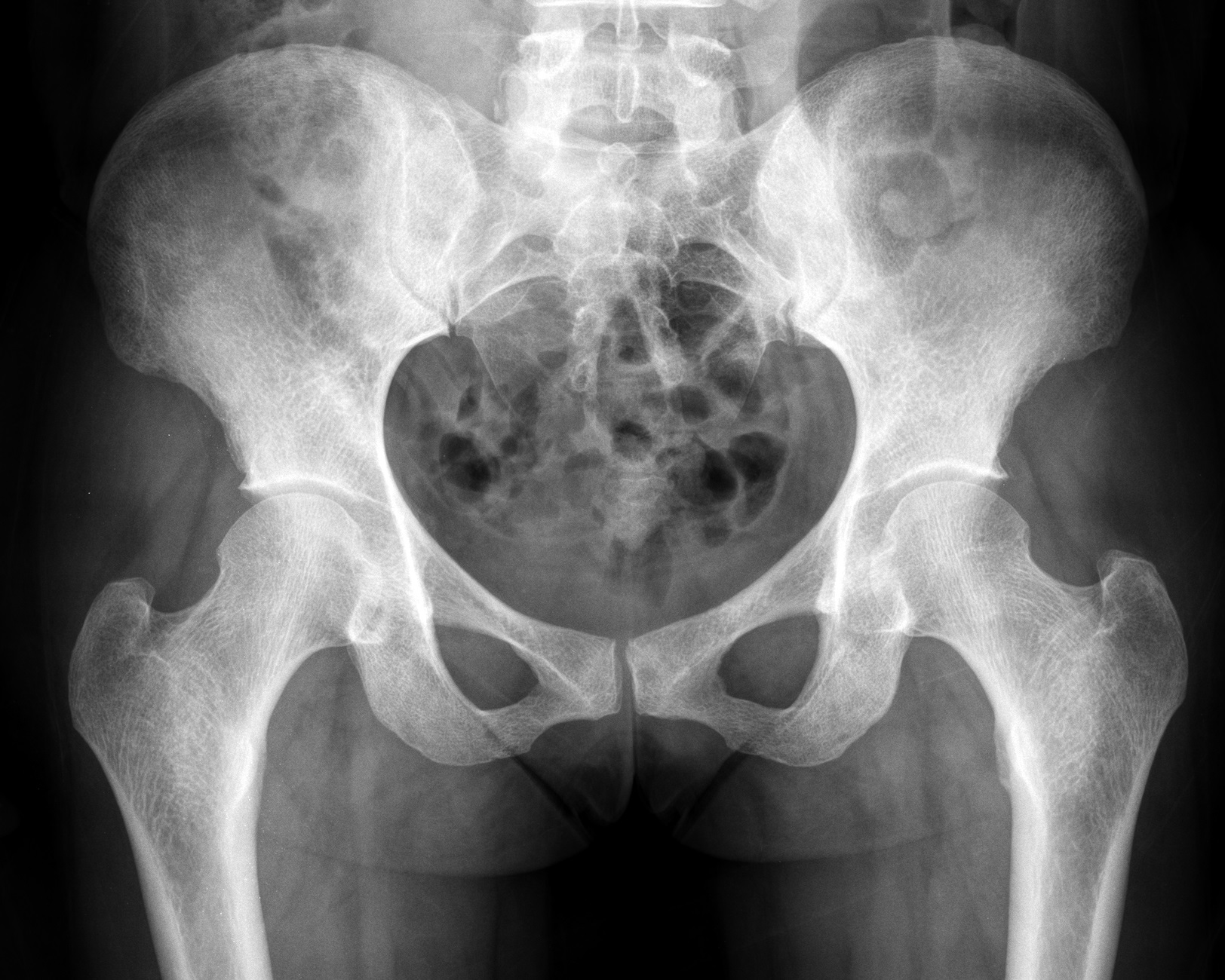 normal hip joint space xray