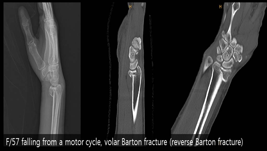 barton fracture