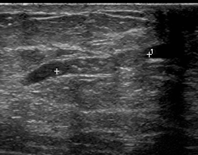 intraductal papilloma sonography)