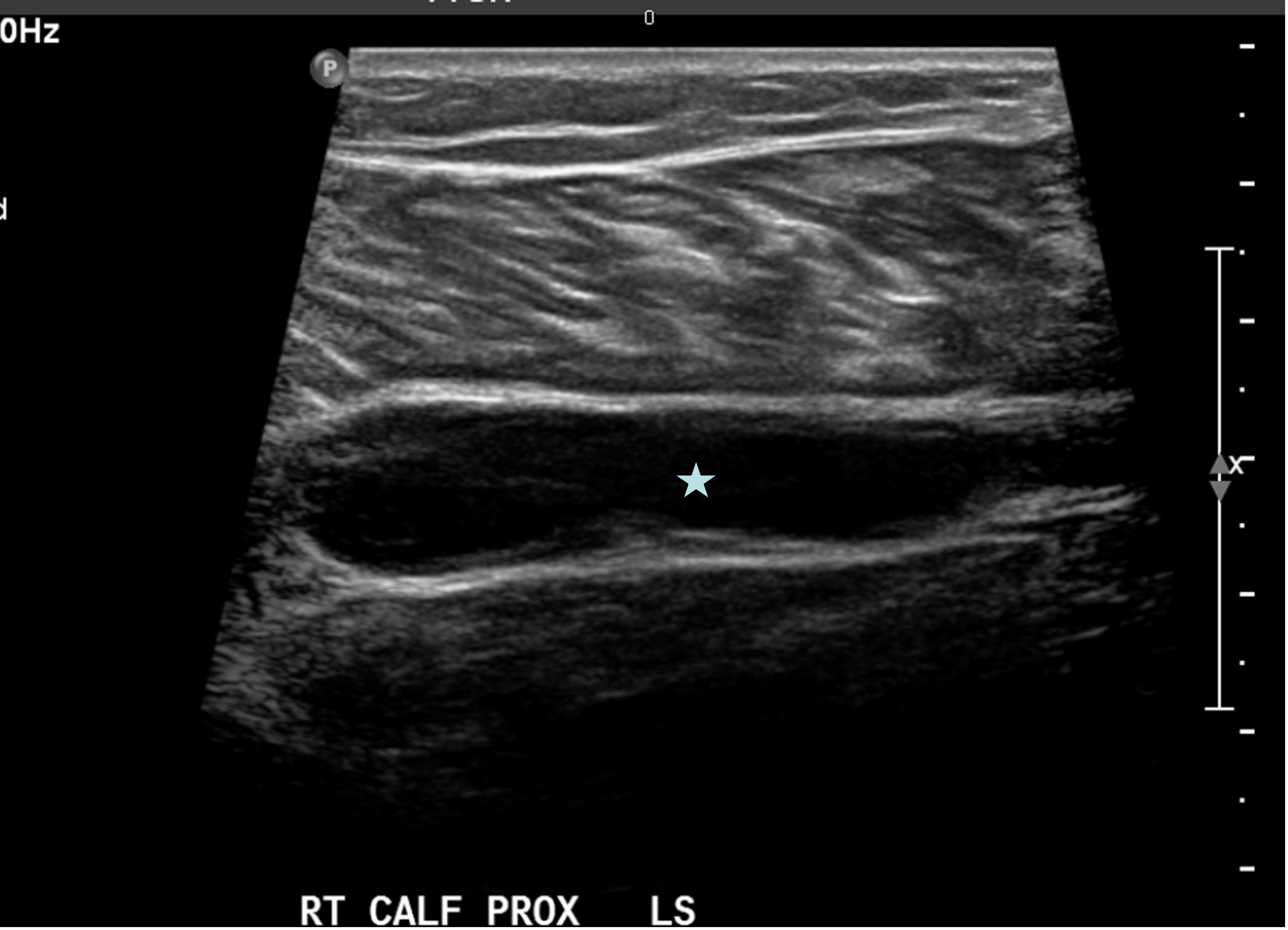 gastrocnemius tear ultrasound