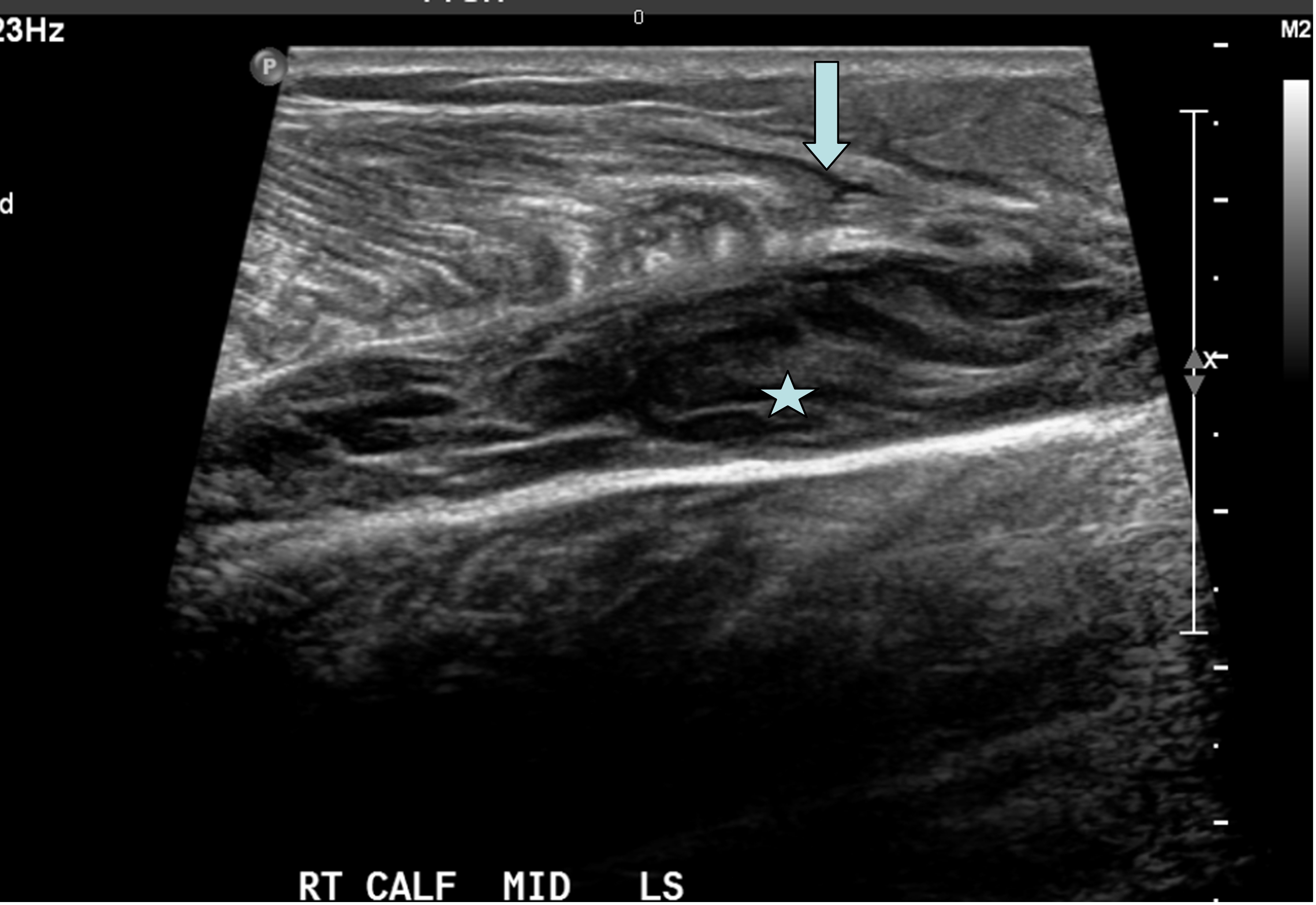gastrocnemius tear ultrasound